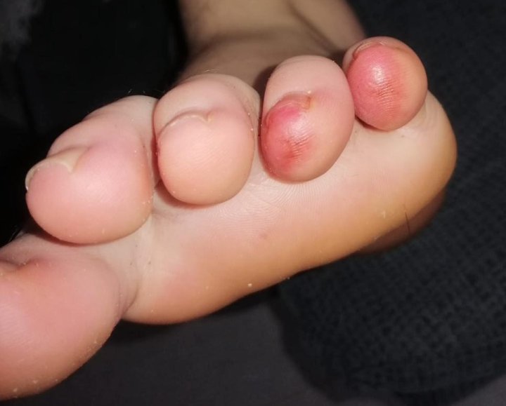 Foto 3_vertoning van huidproblemen aan de tenen bij een 13-jarige jongen voordat een test op het cononavirus heeft plaatsgevonden.